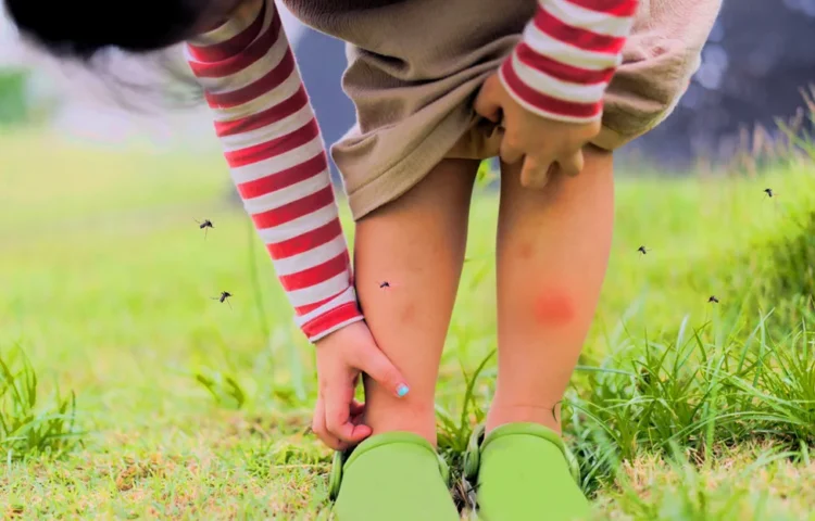 Human legs covered in mosquito bites